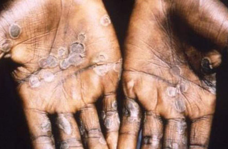 Virginia has its first presumed monkeypox case: report