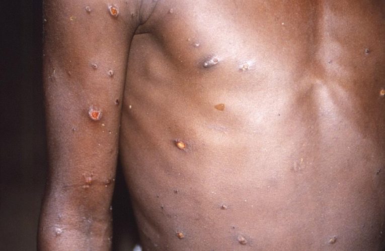 African scientists baffled by monkeypox cases in Europe, US