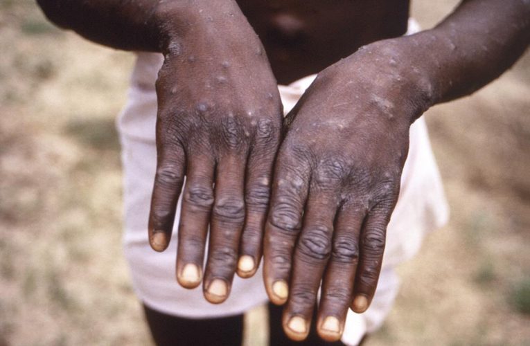 Monkeypox presents moderate risk to global public health, WHO says