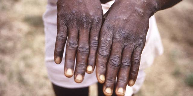 This 1997 image provided by the CDC during an investigation into an outbreak of monkeypox, which took place in the Democratic Republic of the Congo (DRC), formerly Zaire, and depicts the dorsal surfaces of the hands of a monkeypox case patient, who was displaying the appearance of the characteristic rash during its recuperative stage.