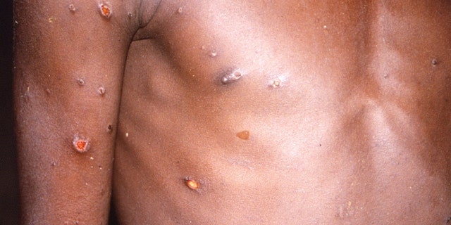 An image created during an investigation into an outbreak of monkeypox, which took place in the Democratic Republic of the Congo, 1996 to 1997, shows the arms and torso of a patient with skin lesions due to monkeypox, in this undated image obtained by Reuters on May 18, 2022. 