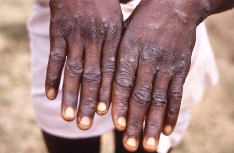 Monkeypox: CDC investigating first US case of the year as growing clusters emerge globally outside Africa