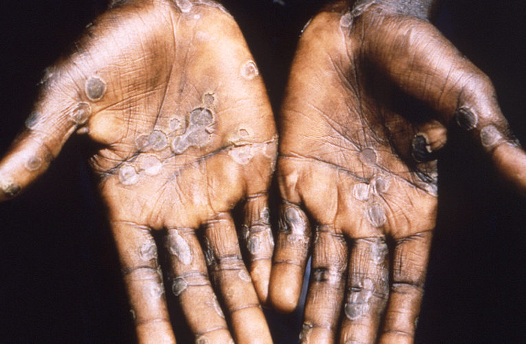 US monkeypox cases climb, another reported in Colorado