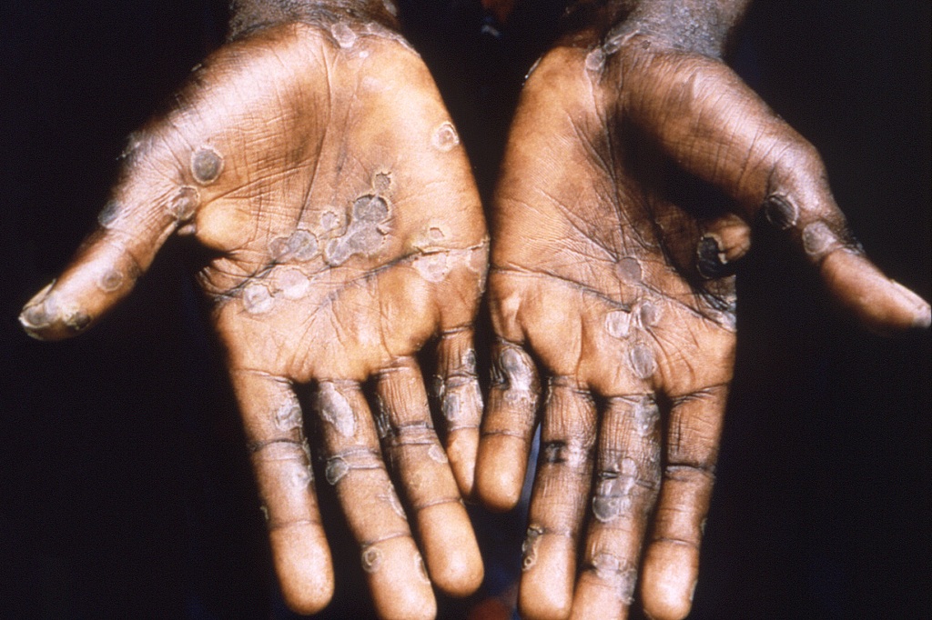 Patients with Monkeypox have symptoms including fever, headache, muscles aches and a developing rash.