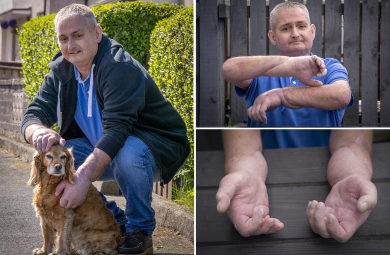 Dad receives ‘world’s first’ double hand transplant