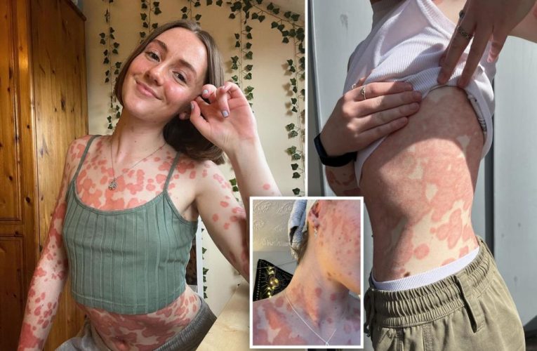 Woman thought she had a sore throat, but it was psoriasis