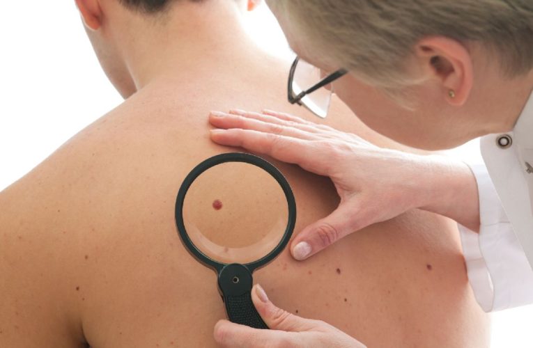 Men’s skin cancer deaths are higher than women’s: New analysis