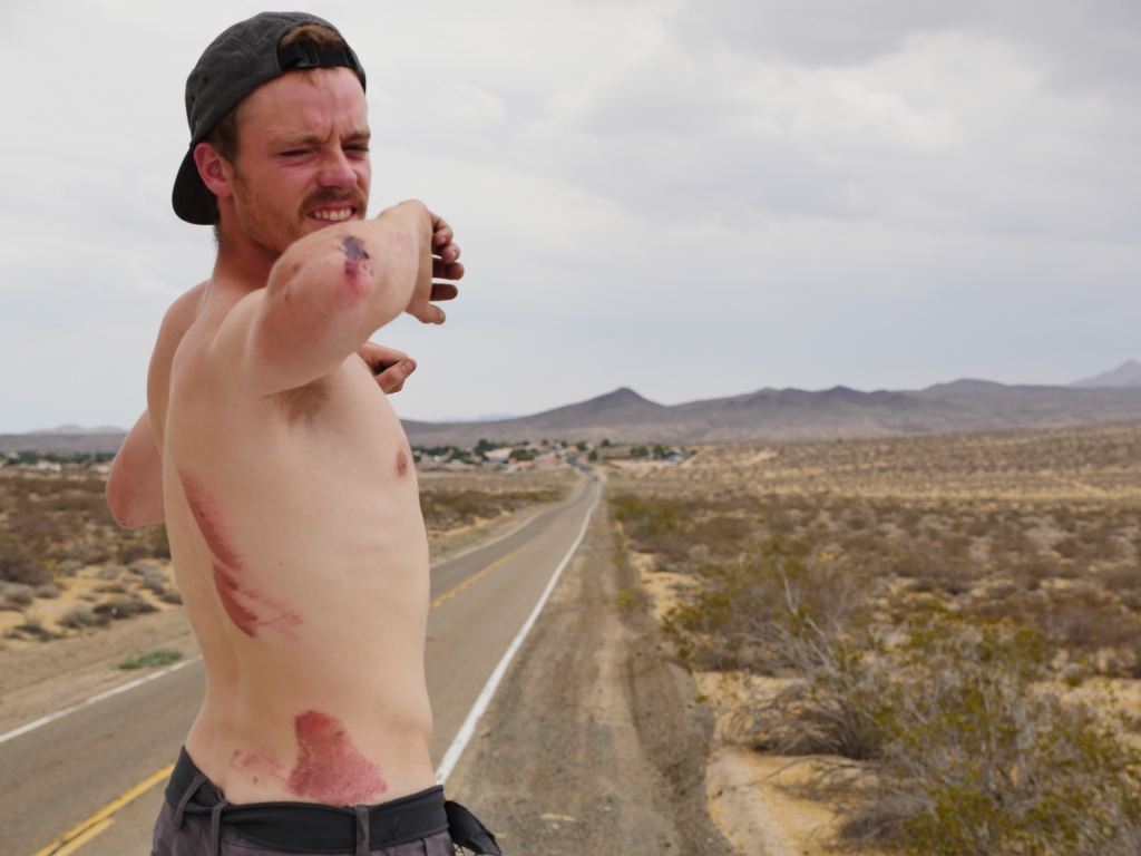 One of the American skaters, Josh, took a nasty spill on a California freeway that resulted in bloody scrapes across his body.