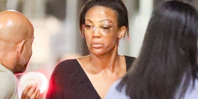 Olympic silver medalist volleyball player Kim Glass gets emotional chatting with friends while taking care of a bruised eye outside a restaurant in Beverly Hills.