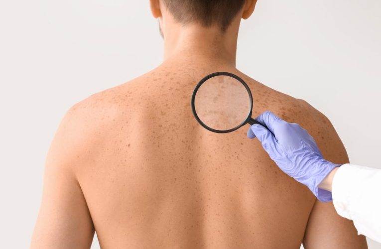 Men suffer more deaths from skin cancer than women, new research shows