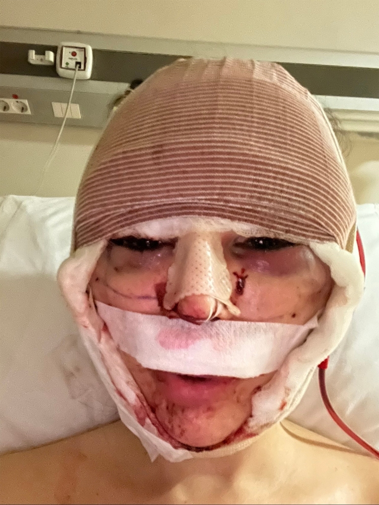 Pamplona is now sharing selfies snapped after her "detransition" surgery in a bid to show the ugly truth about beauty procedures. 