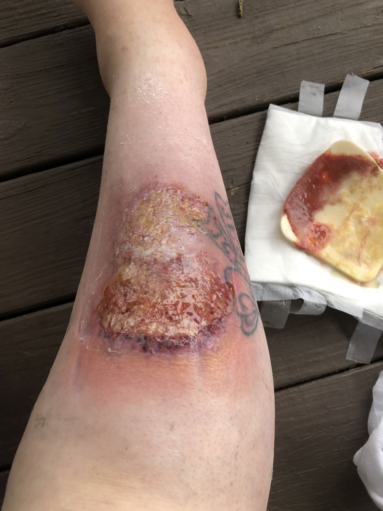 Medics initially diagnosed her with "cellulitis" and tried to scrape the infection off.