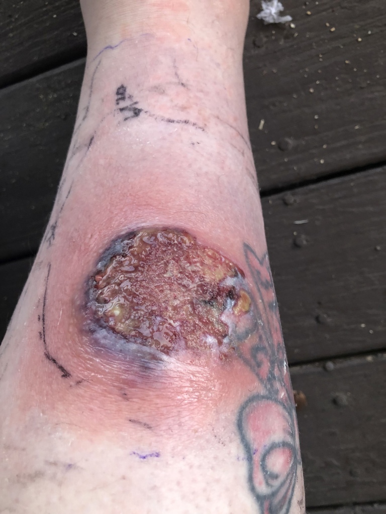 The stay-at-home mother of six specifically suffers from pyoderma gangrenosum, a "rare condition that causes large, painful sores (ulcers) to develop on your skin, most often on your legs," per the Mayo Clinic.