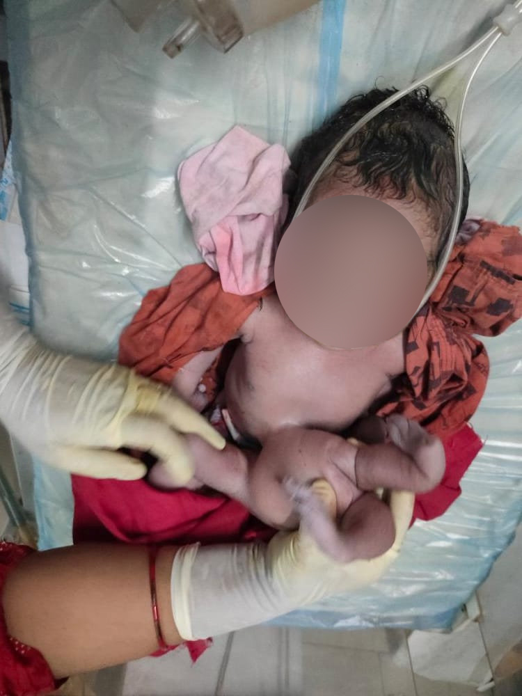 baby born with four extra limbs