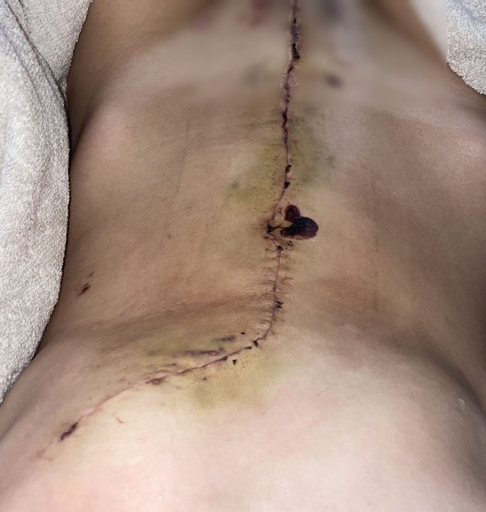Wright underwent surgery to remove the massive tumor, which measured 31 x 29 centimeters and weight a whopping 13lbs. The operation has left her with a 2ft scar  stretching from just under her breast all the way to her pubic bone.