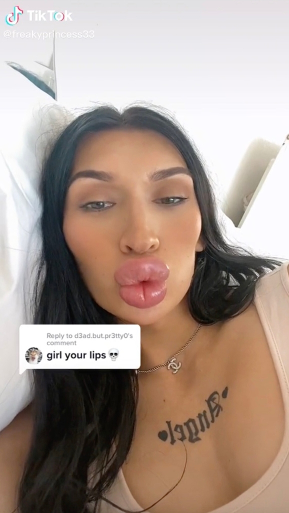 TikToker with lip filler