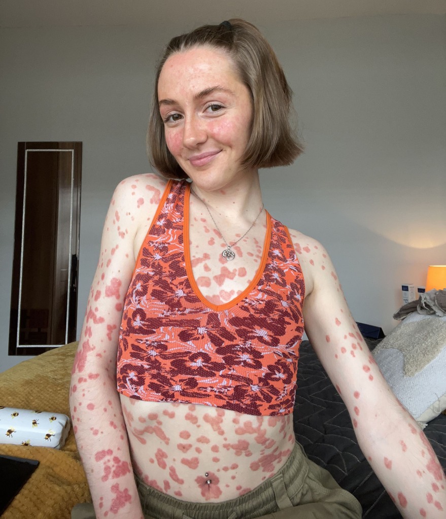 Since Armstrong has unveiled her skin condition on TikTok, the nurse says she's enjoyed a major confidence boost.