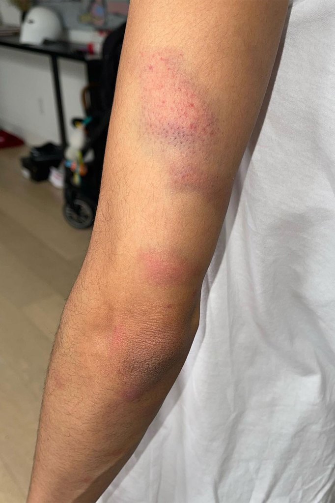 Bruises on Mychelle Johnson's arm.