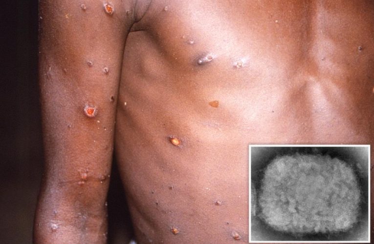 CDC confirms two children diagnosed with monkeypox in U.S.