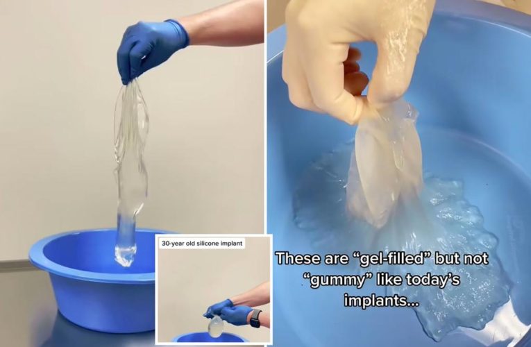 Doctor rips open oozing 30-year-old breast implants in alarming reveal