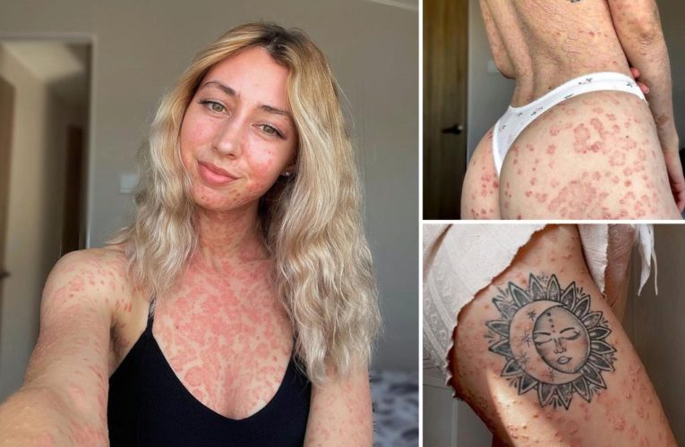 I have severe psoriasis — it took me years to wear a bikini