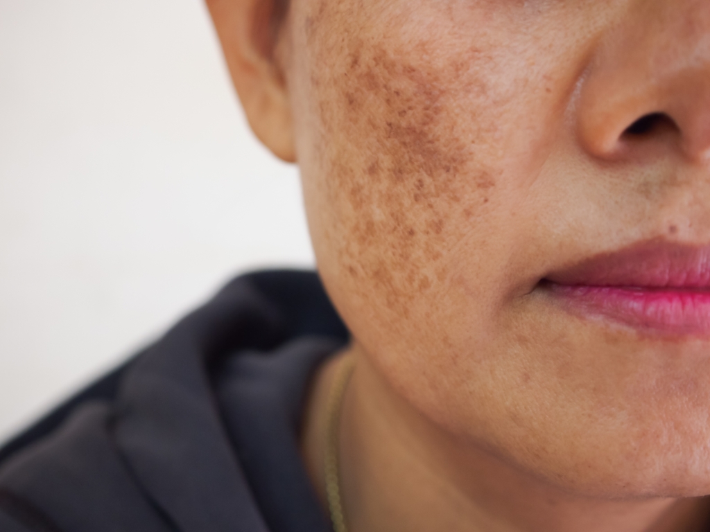 A woman's cheek has intense freckling from dangerous sun exposure.