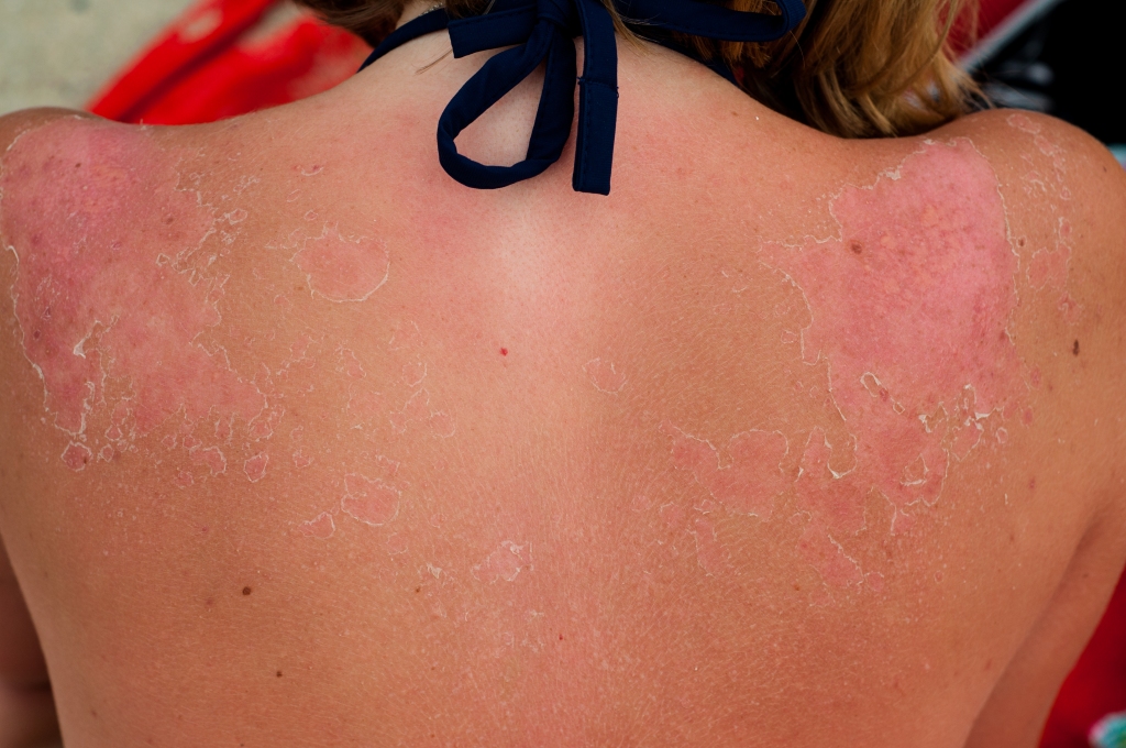 A woman's back is shown to be peeling from sunburn.
