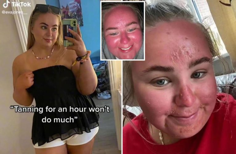 Woman’s face ‘doubles in size’ after spending an hour in the sun