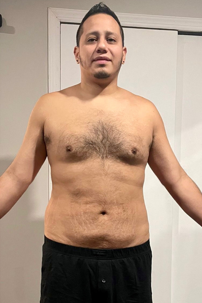 Alfredo Larrea had been diagnosed with a severe case of diabetes before he got ESG in 2020, when he weighed 220 pounds.