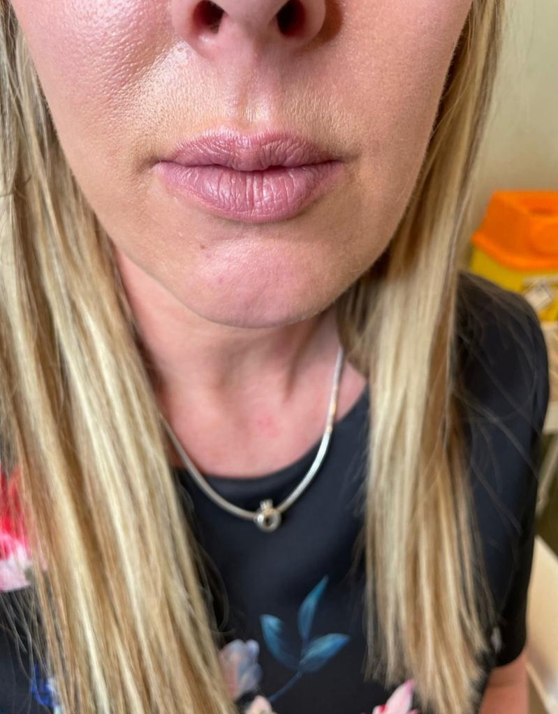 Griffin met a fellow aesthetics practitioner at an advanced training course who dissolved her lips in February and refilled and reshaped them.