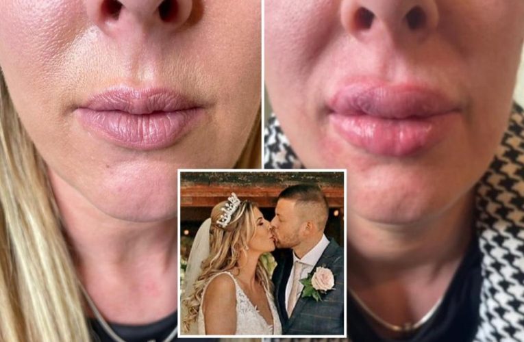 My wedding was ruined because botched filler gave me ‘hot dog’ lips