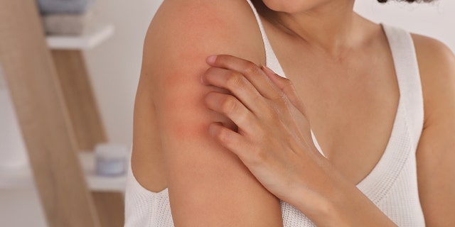 People should try to avoid scratching bug bites; scratching can cause further irritation or infection, say doctors.