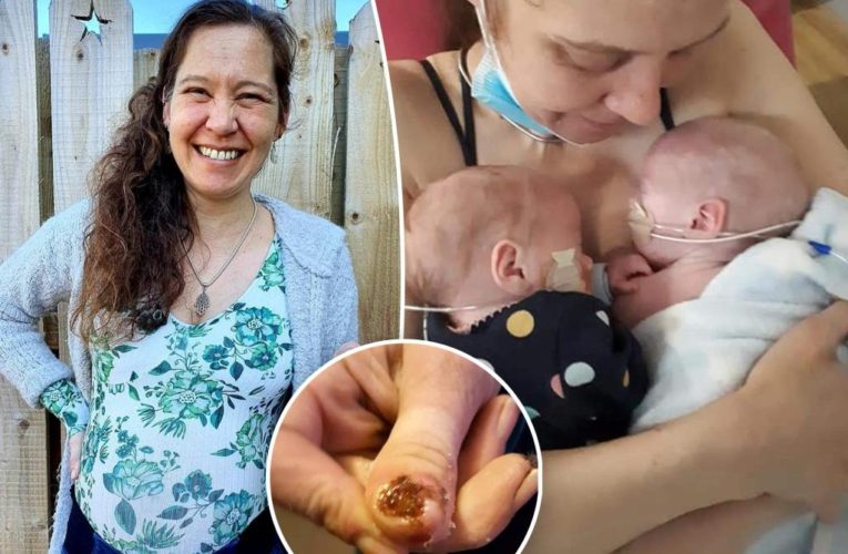 Mom-of-5 with ‘rotting skin’ credits birthing twins to discovering mystery illness