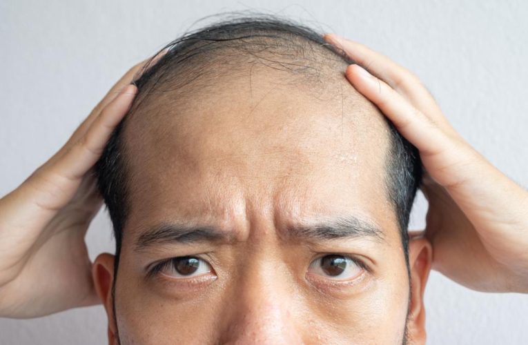 Old, cheap hair-loss pill is doing wonders for baldness