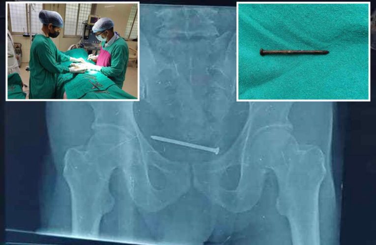 Man had 4-inch nail lodged in bladder — for an entire year