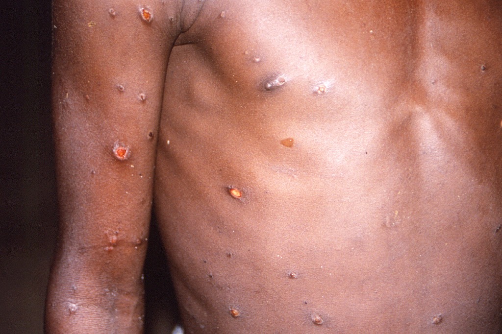 This 1997 image provided by CDC, shows the right arm and torso of a patient, whose skin displayed a number of lesions due to what had been an active case of monkeypox.