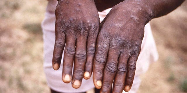 This 1997 image provided by the CDC during an investigation into an outbreak of monkeypox, which took place in the Democratic Republic of the Congo (DRC), formerly Zaire, and depicts the dorsal surfaces of the hands of a monkeypox case patient, who was displaying the appearance of the characteristic rash during its recuperative stage.