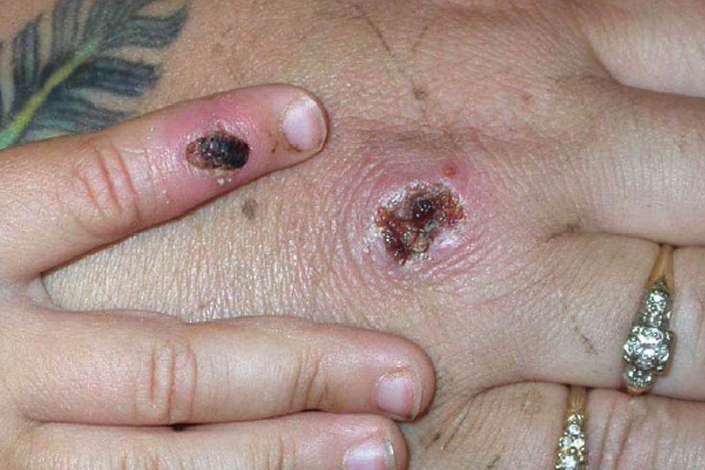 monkeypox scabs 