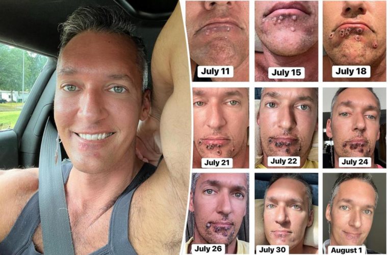 Monkeypox patient shares timeline selfies showing how lesions grew over his face