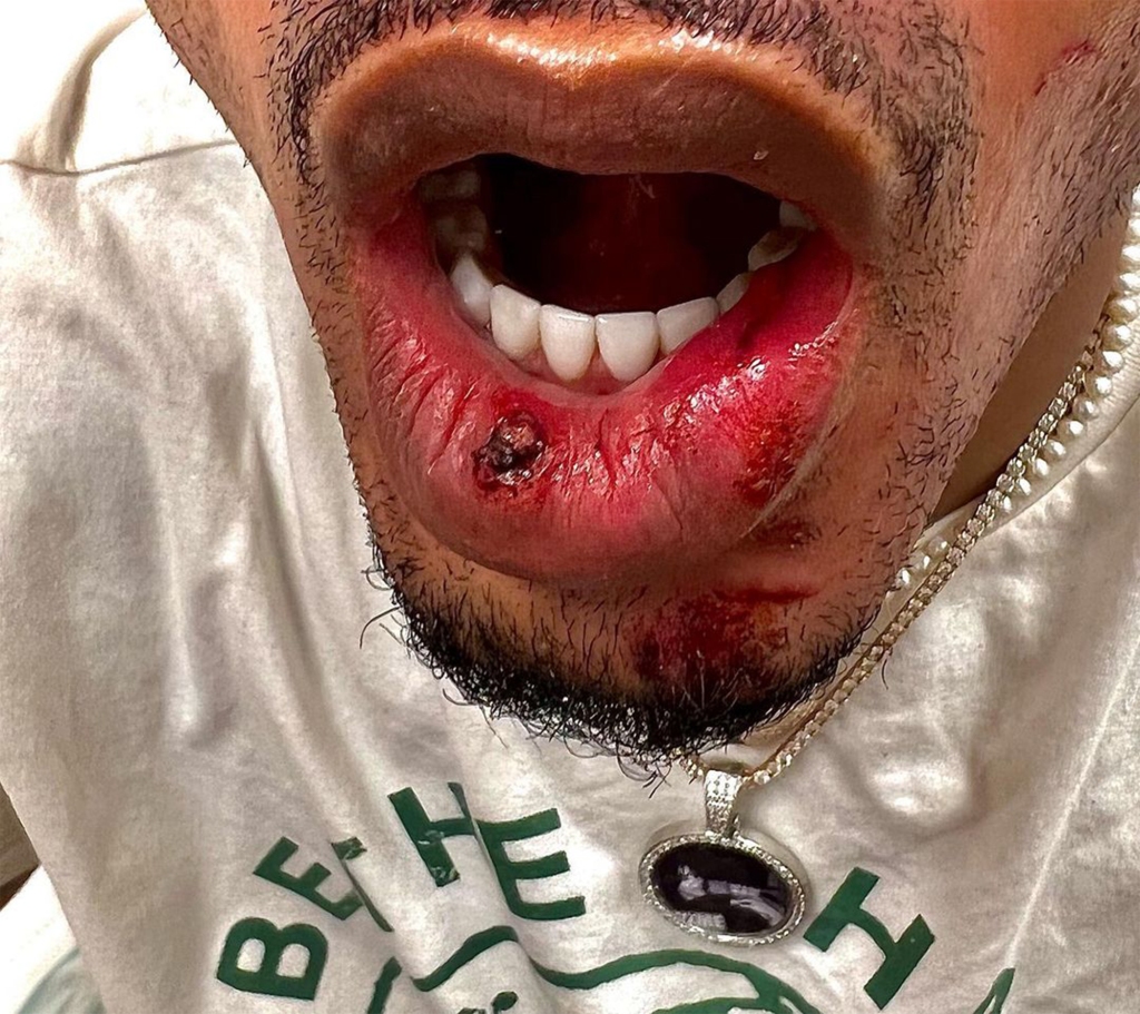 Following the alleged encounter, Alsina shared images of his wounds on Instagram. 