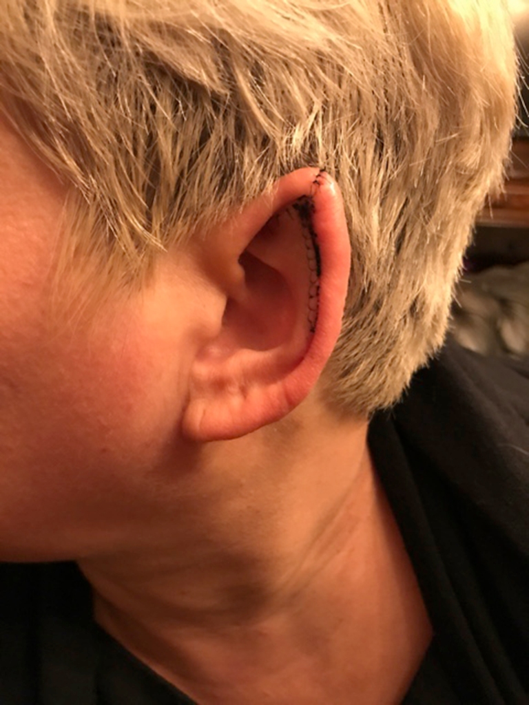 Black shared photos of her ears following the procedure.