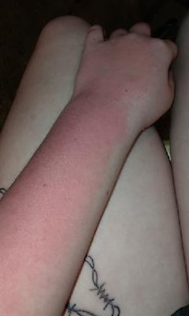 Aquagenic urticaria is a rare condition that causes a person's skin to erupt in red, itchy hives if exposed to water.