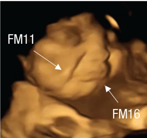 An ultrasound scan of a fetus that appears to be scowling.