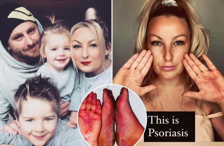 Mom of 6 can’t wear most shoes because of debilitating eczema
