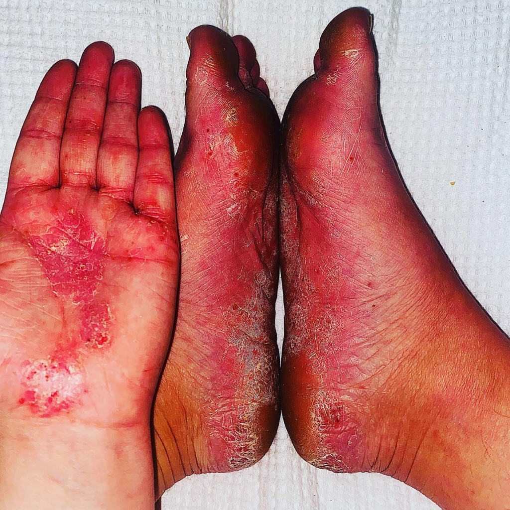 A picture of Nicole Preece's hands and feet, covered in psoriasis.