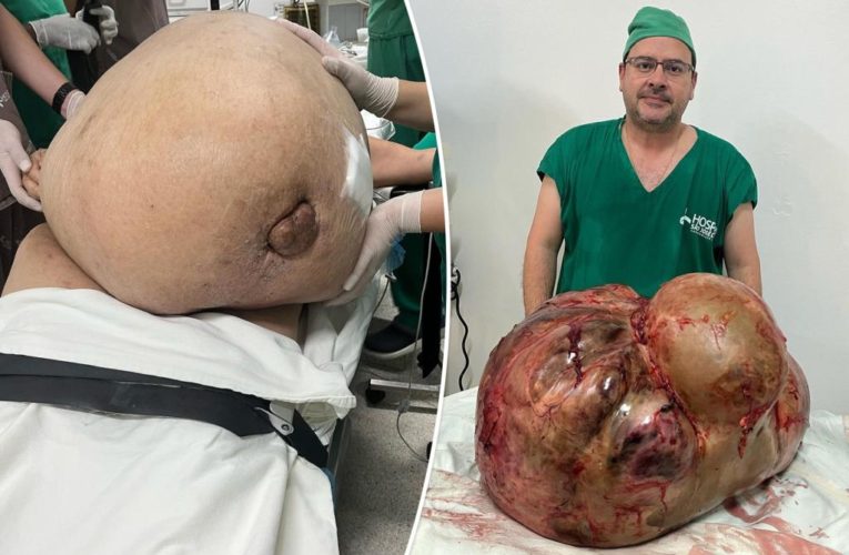 Woman lived with 100-pound tumor for 5 years, surgeon stunned
