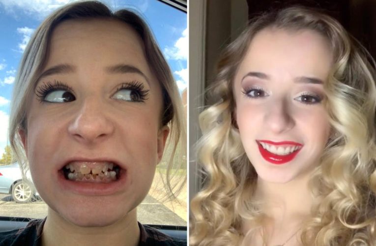 I was born with ‘transparent’ teeth and needed dentures at 19