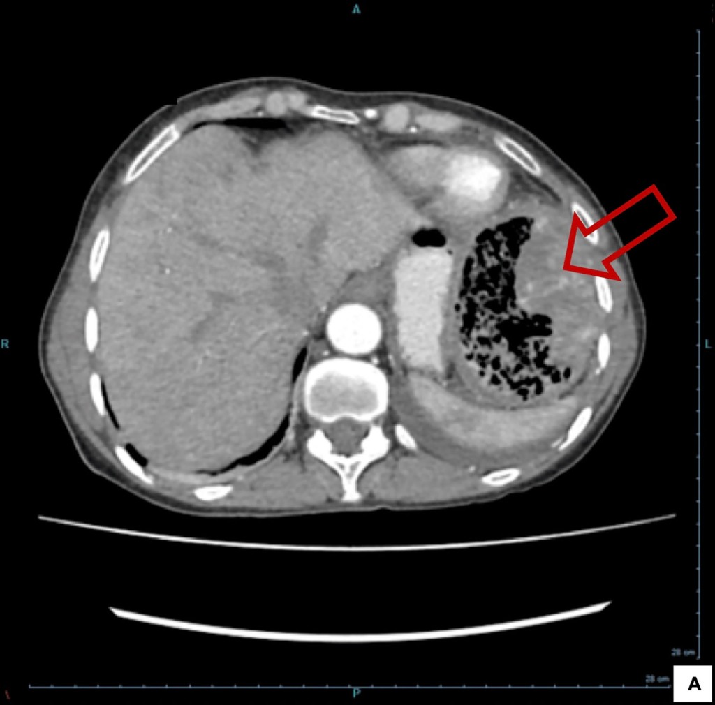 Interestingly, the patient remained "asymptomatic" for nearly the entire 20 years the medical accessory was in her body.