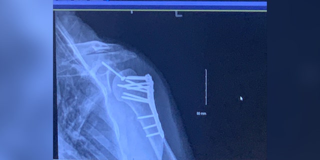 Dustan Jackson shared this image he says shows doctors' work to reconstruct his injured left shoulder.