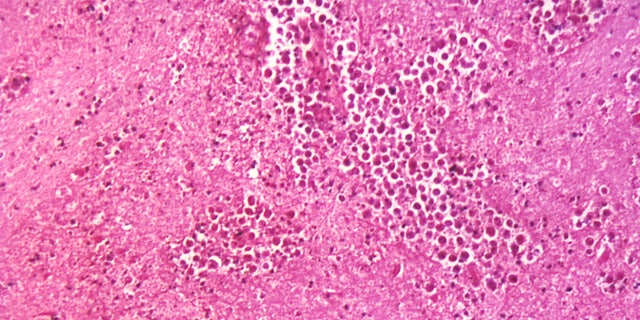 Under a magnification of 125X, this photomicrograph of a brain tissue specimen depicts the cytoarchitectural changes associated with a free-living, Naegleria fowleri, amebic infection. 